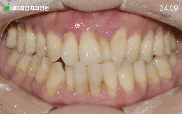 사당역치과 앞이빨 흔들림, 무조건 뽑아야 할까? 앞니 임플란트가 필요한 경우