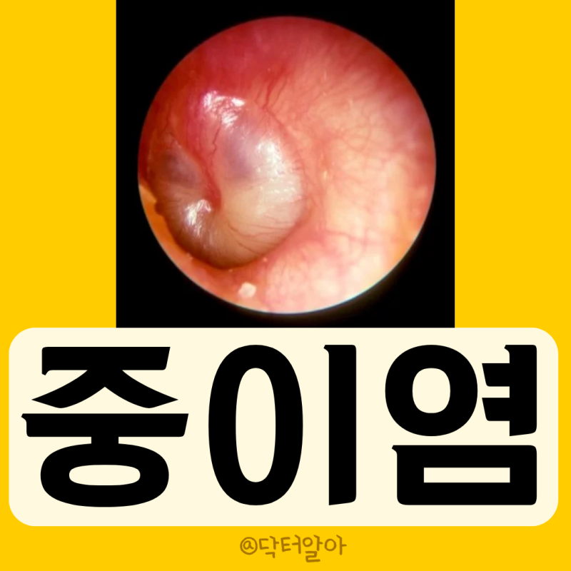 의사가 설명하는 중이염 정의 증상 원인 진단 치료 예방