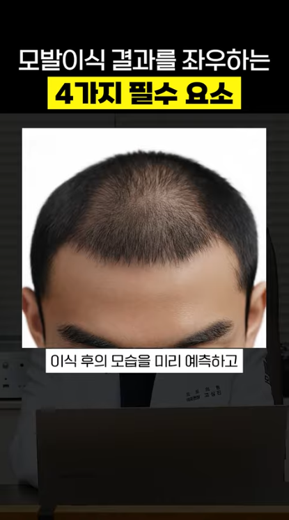 서면모발이식, 탈모약을 먹어도 계속 빠진다면