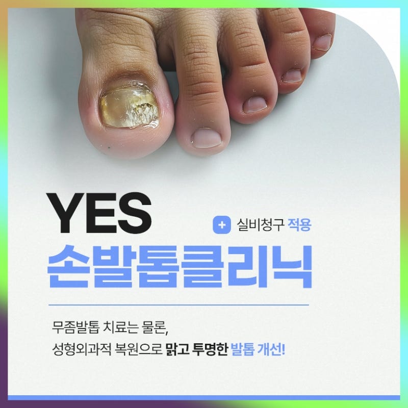 인천발톱무좀 치료 병원, 여름철 무좀에 레이저 방식을 고려한다면