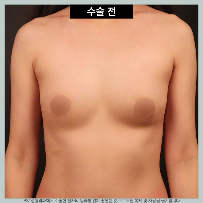 가슴 지방주입, 자연스럽게 커지고 싶다면