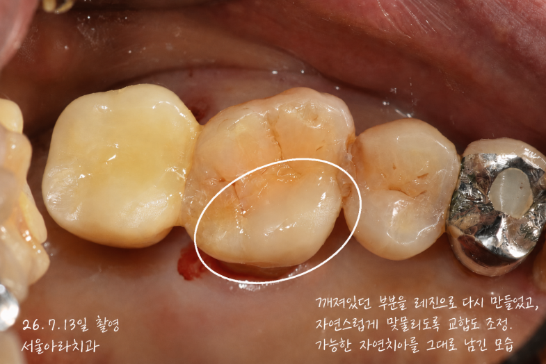 안양치과 어금니가 깨졌는데 꼭 크라운 해야 할까? 레진빌드업 치료 사례