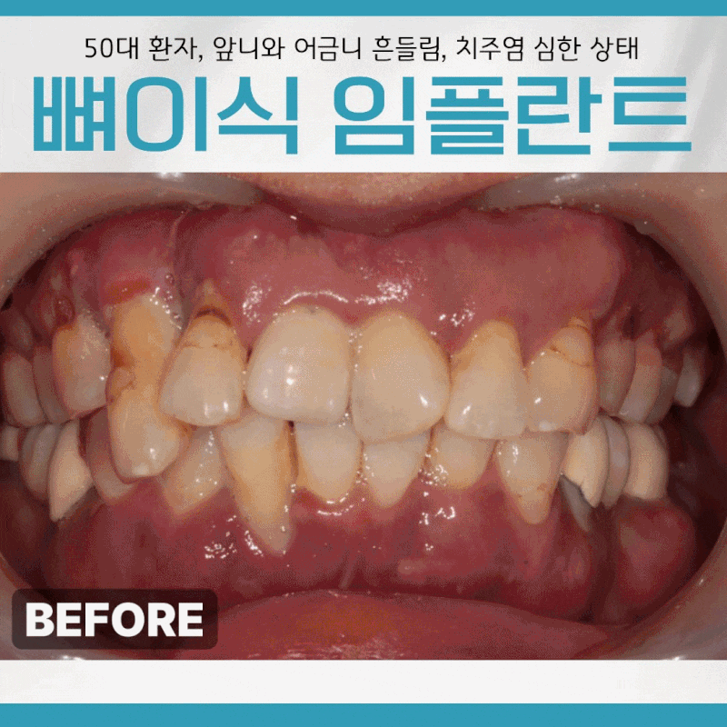 서울 임플란트, 심한 치주염으로 인한 앞니 어금니 흔들림, 발치 즉시 뼈이식 임플란트 사례