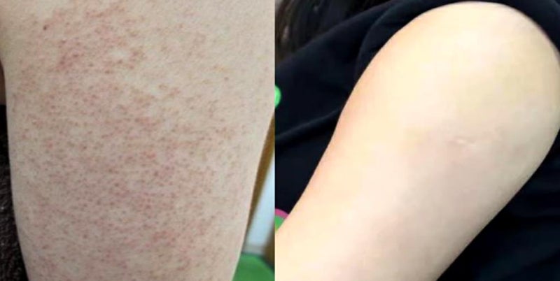 팔 모공각화증 피부 오돌토돌 좁쌀 두드러기 N년차의 관리법