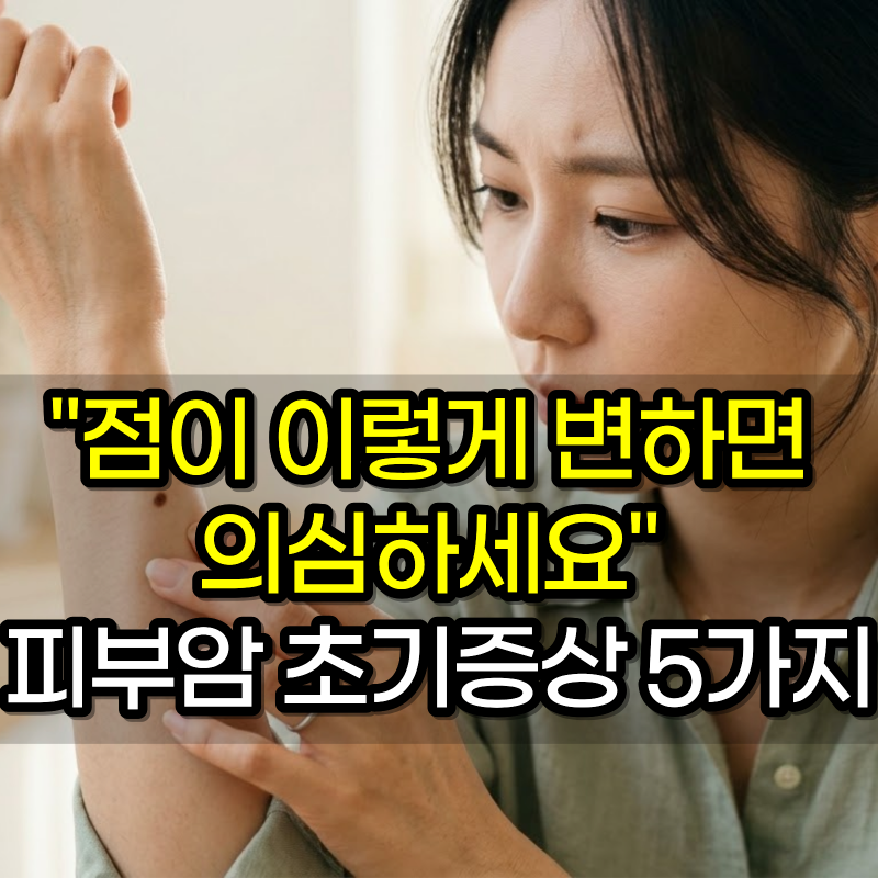 "점이 이렇게 변하면 의심하세요" 피부암 초기증상 5가지