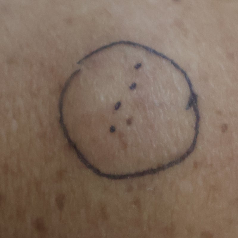 대구 등지방종 염증처럼 보이는 경우는 어떻게 치료할까요?
