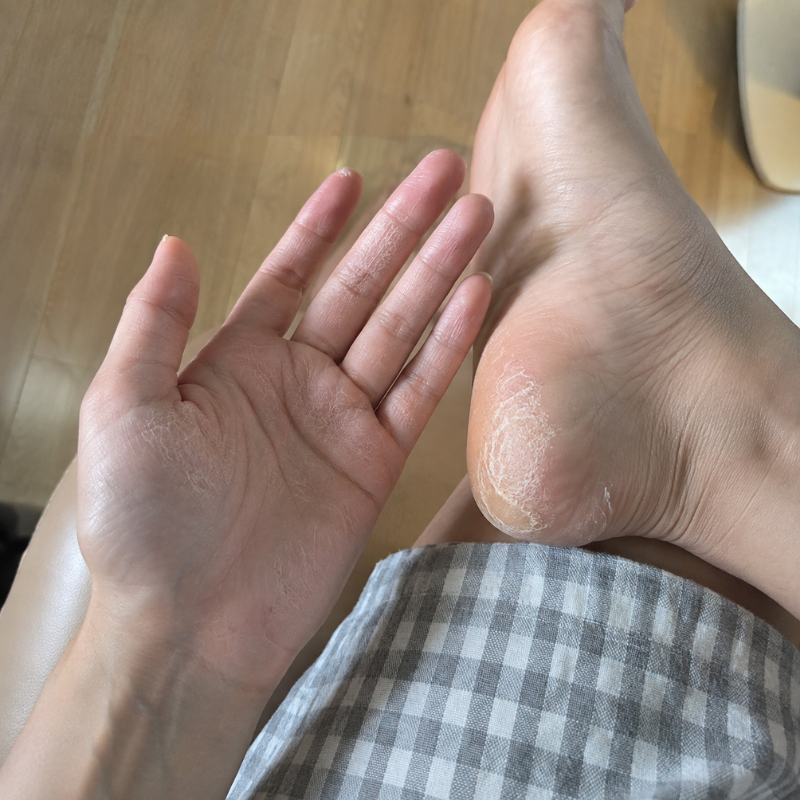 손 발바닥 굳은살 연고 바르고 촉촉한 피부로 돌아왔음