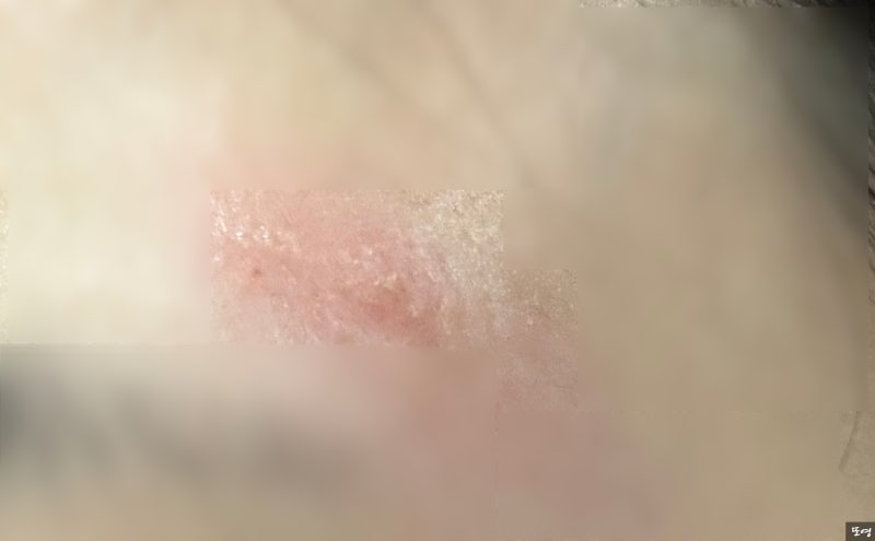 [대상포진] 이마 헤르페스? 대상포진? 물집 생겨서 병원갔더니..시간 별 경과 사진有, 헤르페....