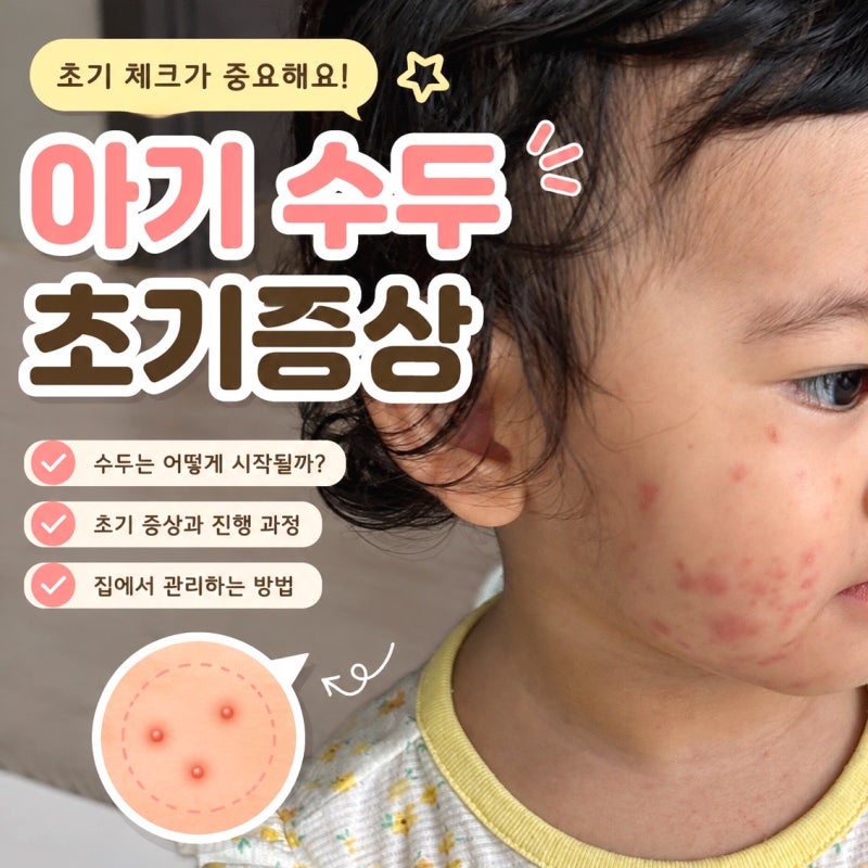 아기 수두 초기증상 어떻게 시작될까? 예방접종 시기와 전염 기간 총정리