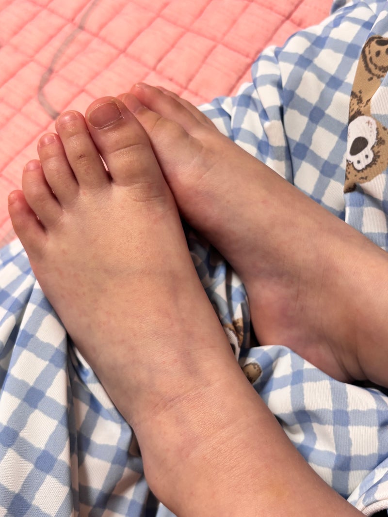 아기 수족구 보험 청구 필요서류 유의사항 | NH농협손해보험 감염병 진단비 30만원 지급받은 ....