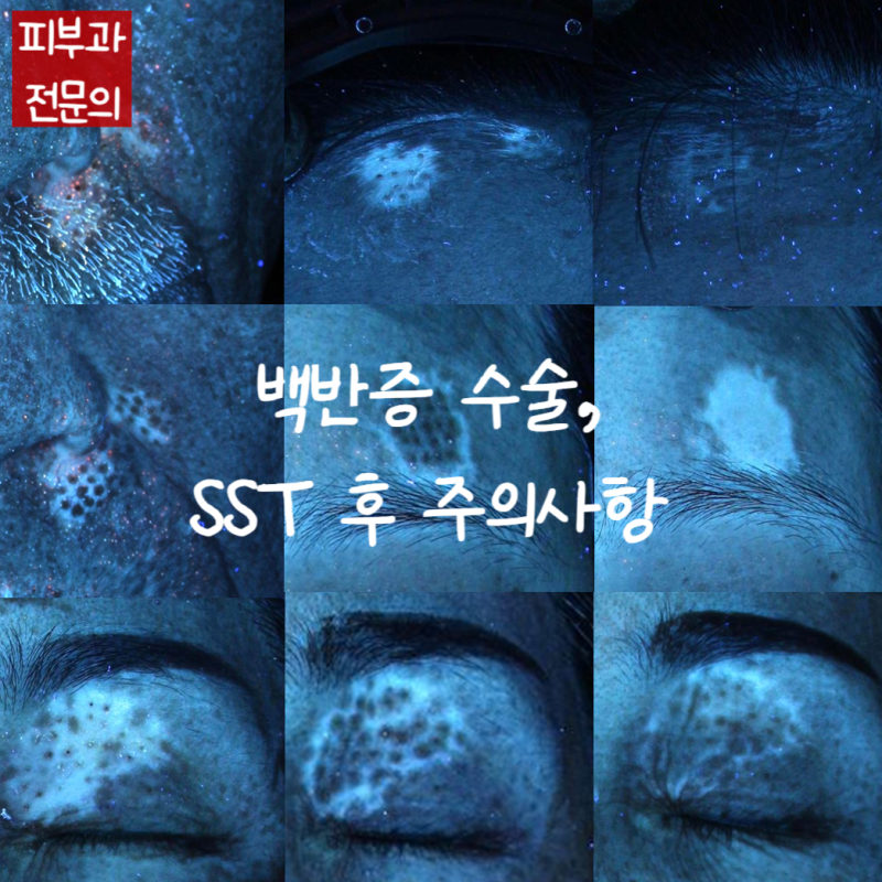 백반증 수술, SST 후 관리법, 주의사항
