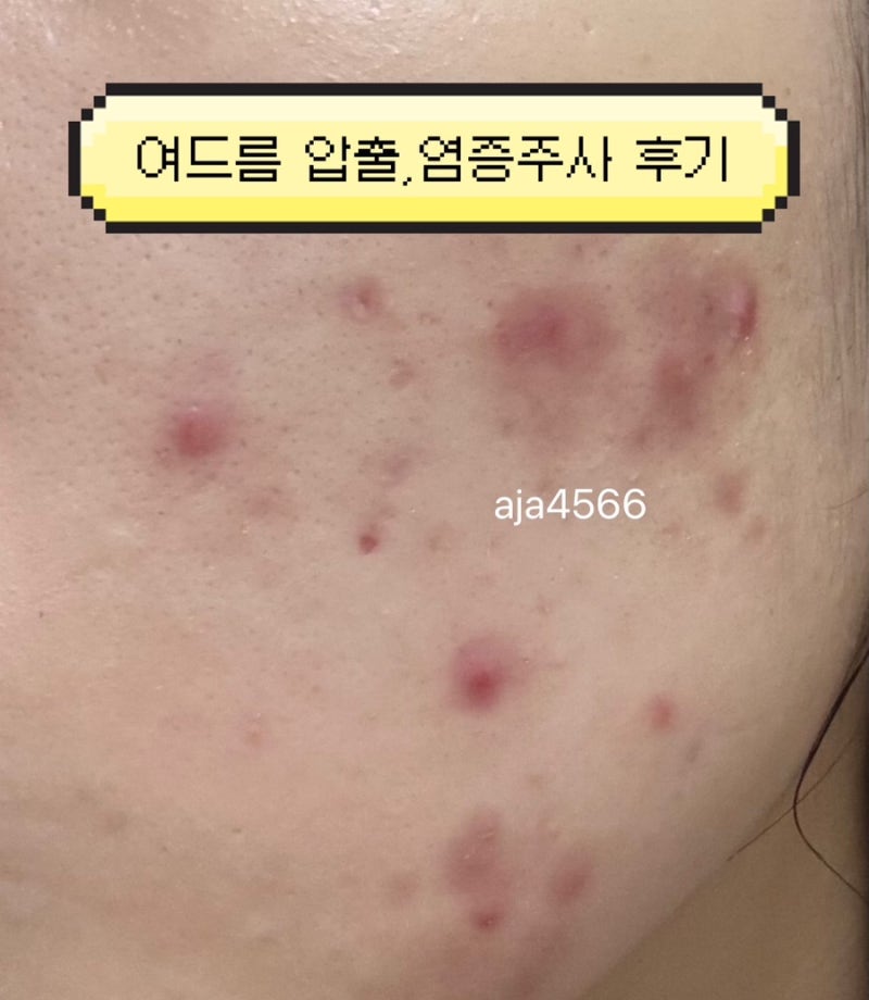 여드름 압출 및 염증주사 비추천하는 이유는 ?! 솔직후기 및 2주전후사진