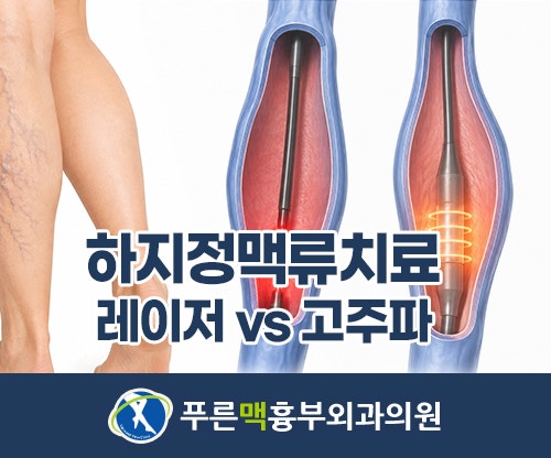의정부 하지정맥류 치료, 레이저와 고주파 방식 비교