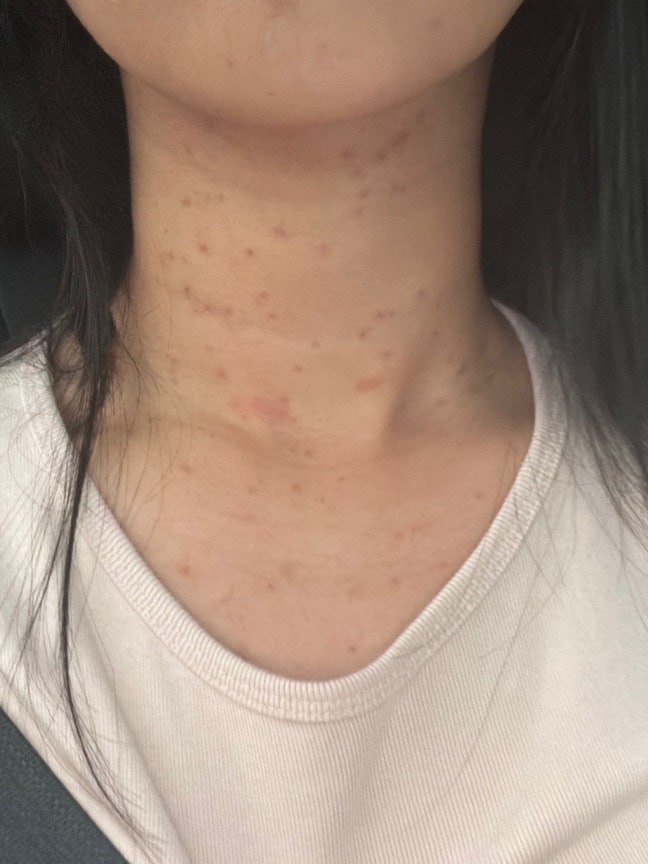 광주 편평사마귀, 비립종, 점제거 성지에서 편사 1000개 뺀 솔직 후기 (+경과도 있음)