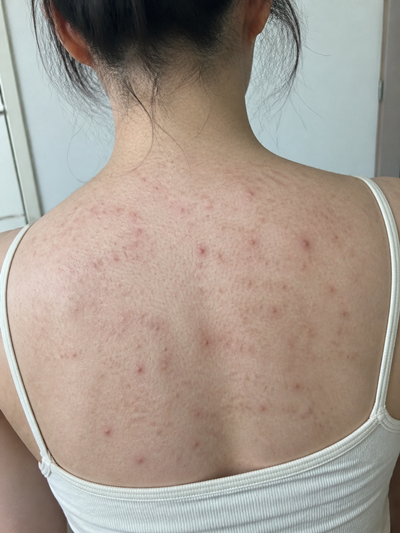등드름 흉터 없애는 법 3가지 홈케어 vs 피부과 비교 분석