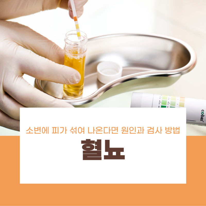 남자 혈뇨 소변에 피가 섞여 나온다면 원인과 검사 방법