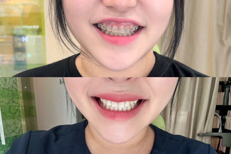 치아 교정 후 거미스마일 개선 방법은? 잇몸성형과 구강전정술