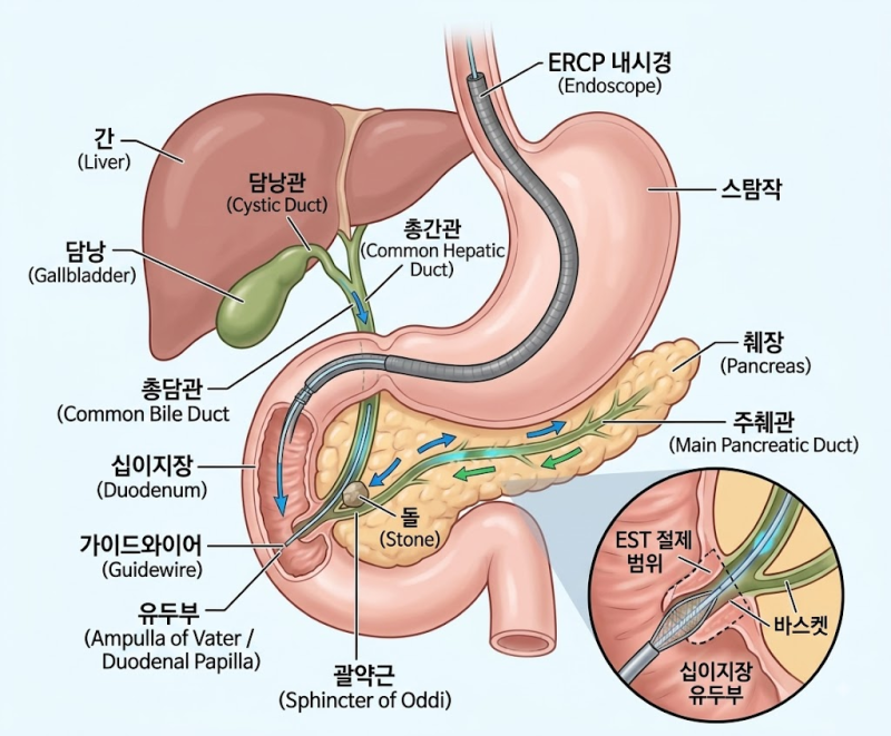 ERCP 내시경적 역행 담췌관 조영술 적응증과 시술 전후