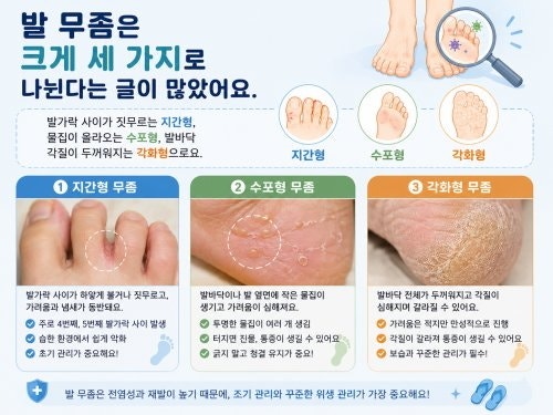 수포형 증상에 맞는 무좀약 고르는 기준과 바르는 방법