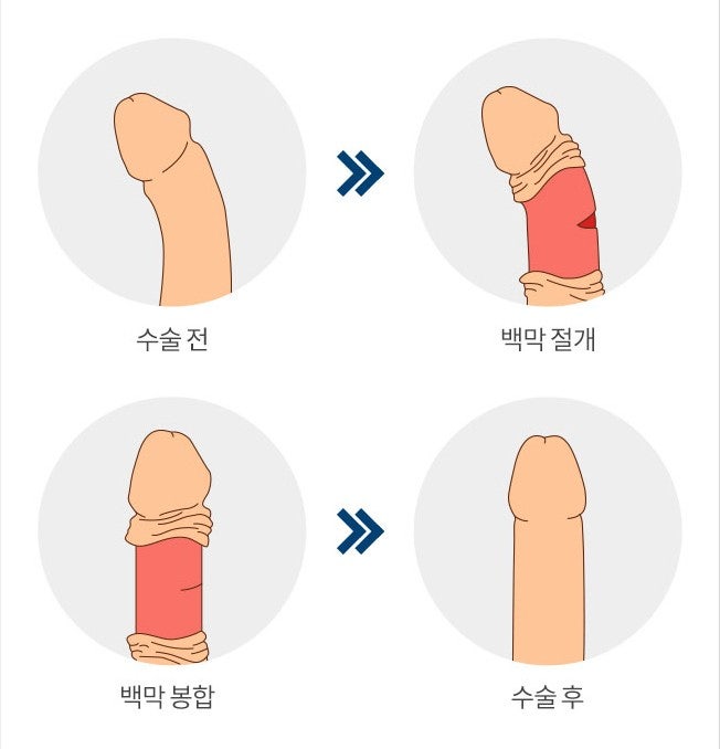 페이로니병과 음경만곡증 수술