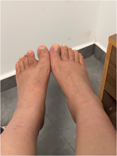 인버브발톱패치만 믿다 샌들 다 버릴 뻔한 썰