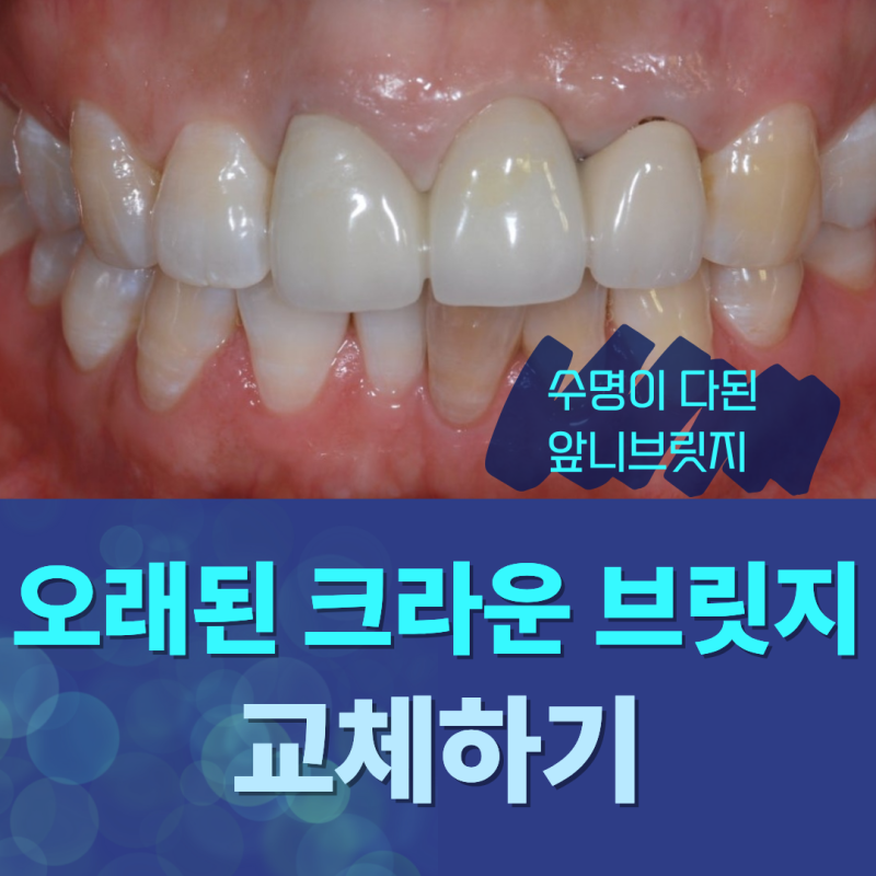 수원치과 오래된 앞니브릿지 재보철 교체가 필요한 이유는?