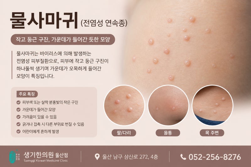 울산 아이 피부에 오돌토돌한 물사마귀, 전염되기 전에 확인하세요