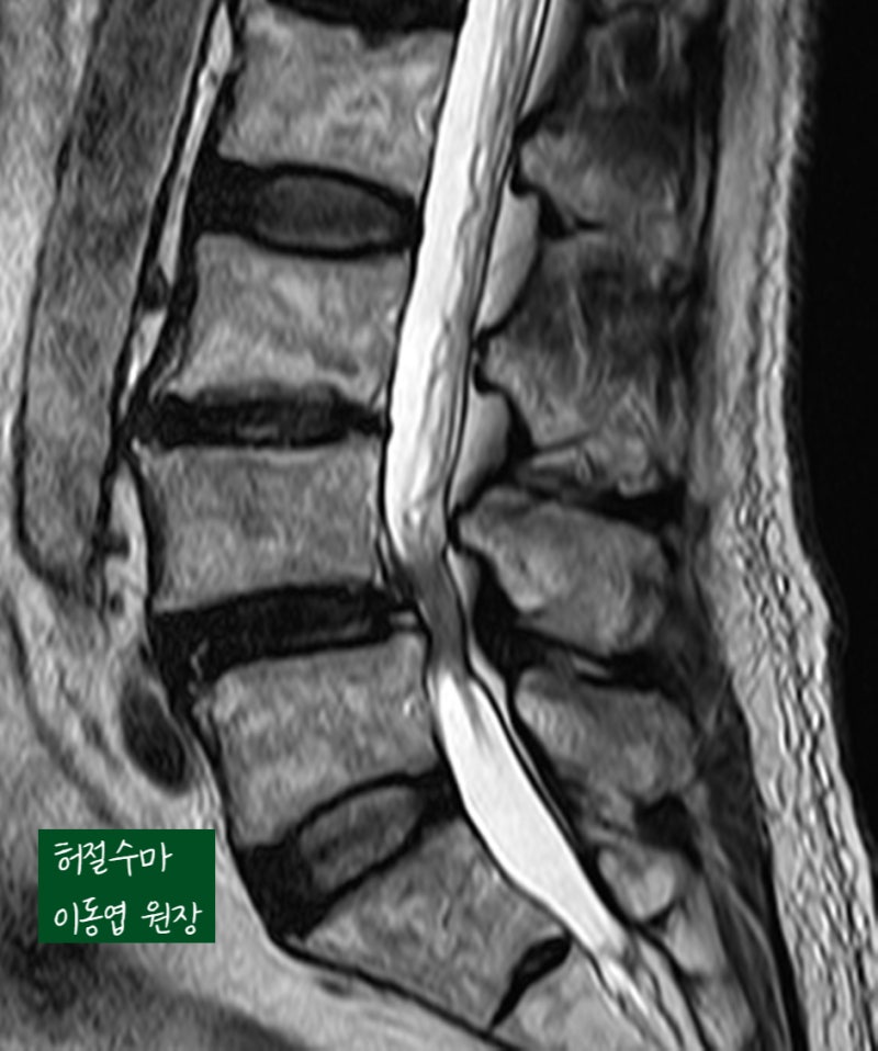 척추전방전위증과 척추관협착증, 나사못 고정없이 수술하는 방법