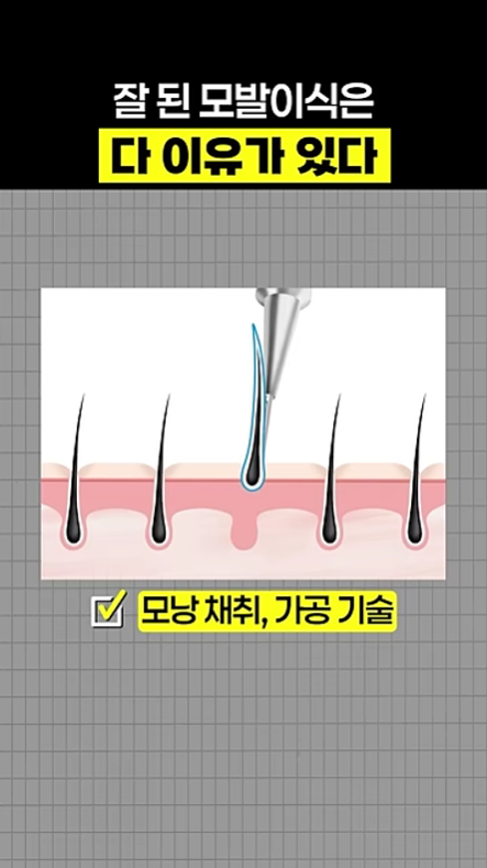 부산 탈모성지, 후기가 좋아도 결과가 다른 이유