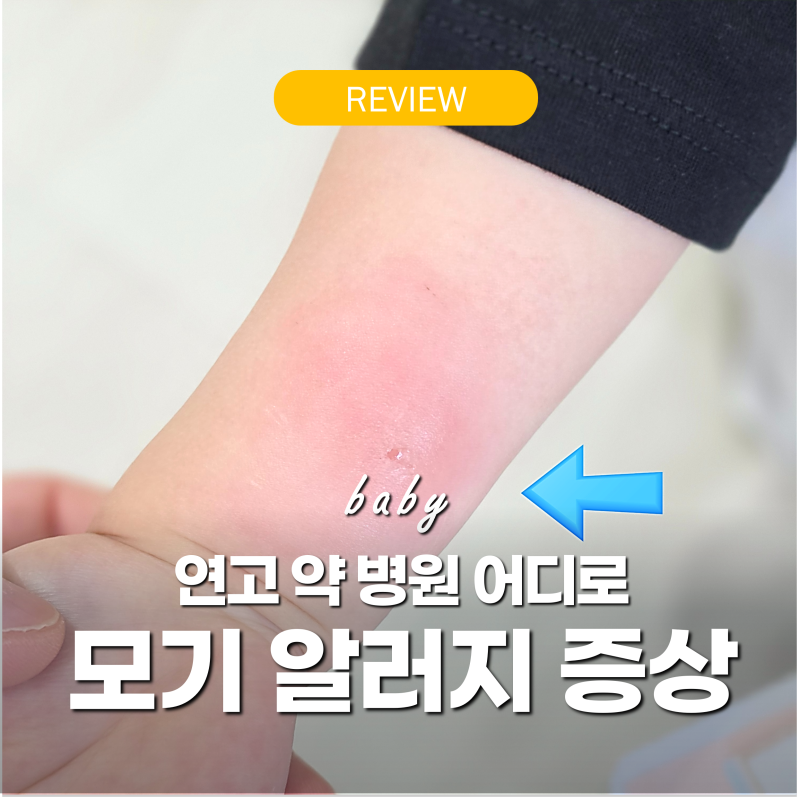 아기 모기 알러지 증상 '버물리 말고 연고 이거!' 병원 어디로 약 후기