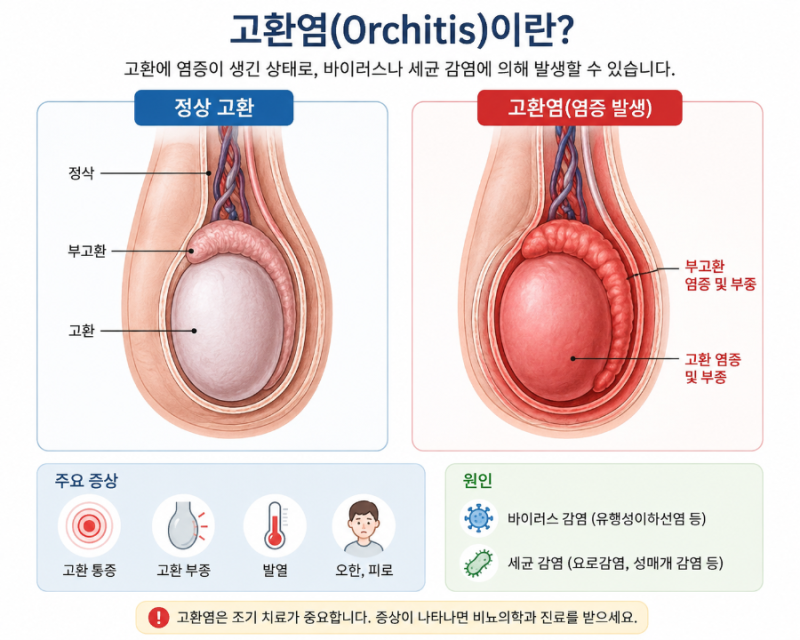 "갑자기 고환 통증이 생겼다면? 고환이 붓고 아프다면?" '고환염'의 원인, 종류, 증상, 부고환....