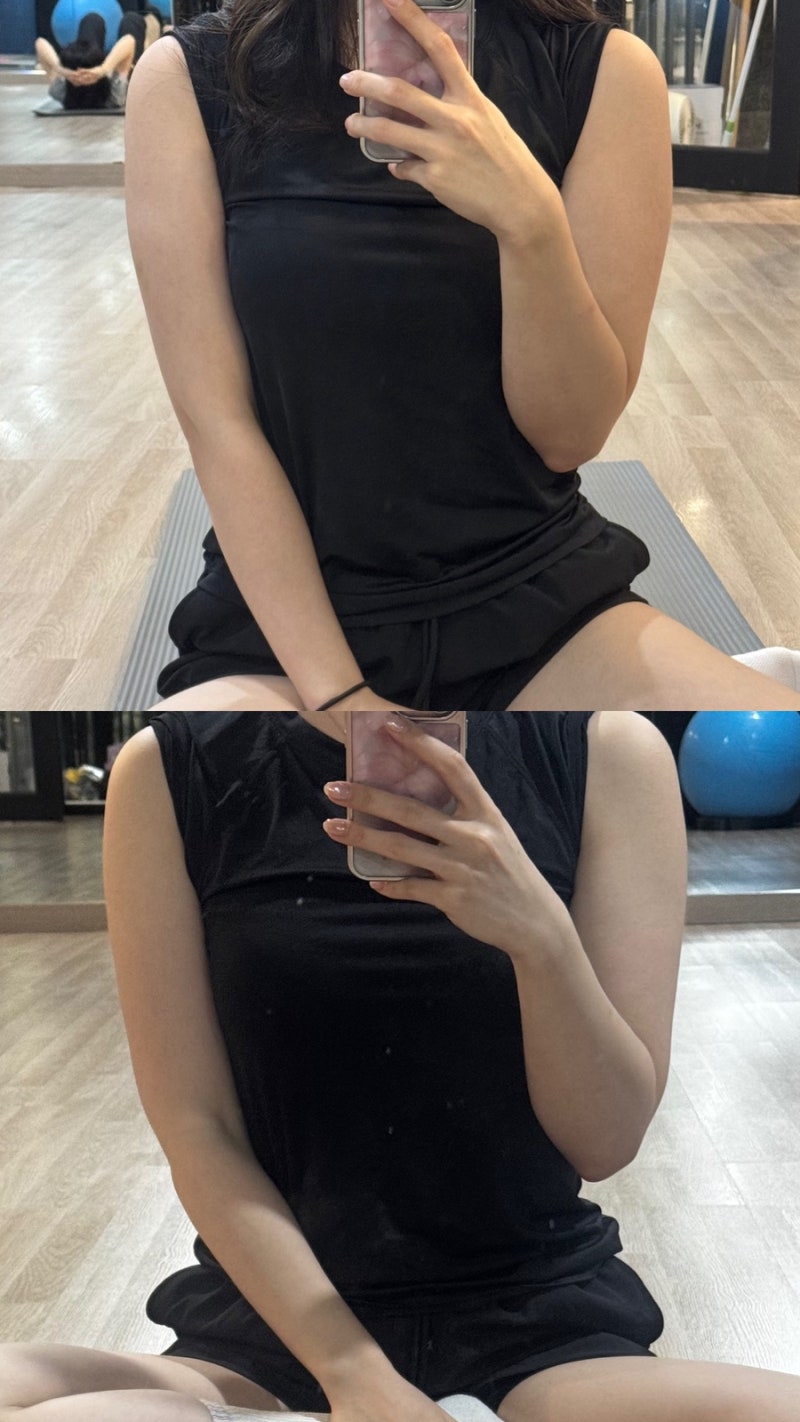 분당 다이어트 팔뚝 지방추출주사 2주차 감동 후기(시술 전후 비교 사진)