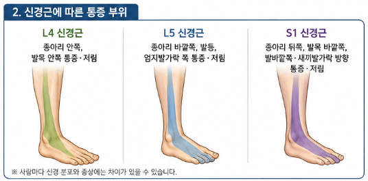 허리디스크 환자가 발목이 아픈 이유｜증상·원인·치료방법