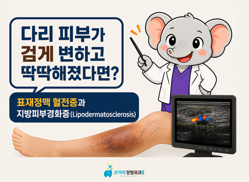 다리 피부가 검게 변하고 딱딱해졌다면? - 표재정맥 혈전증과 지방피부경화증(Lipodermatosclerosi....