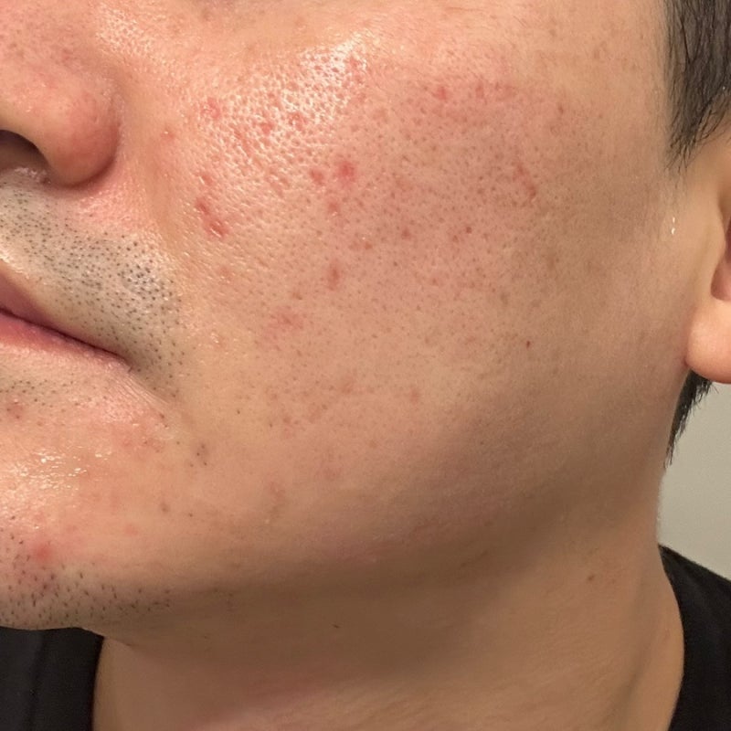 여드름 패인흉터 치료 성지에서 곰보피부 셀라스 레이저시술 가격 후기