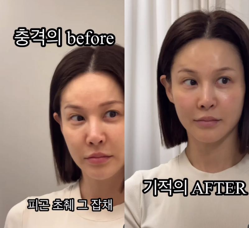 청주 눈밑지방재배치, 아이비가 받고 극찬한 '벨루티 레이저',뭐가 다르길래?