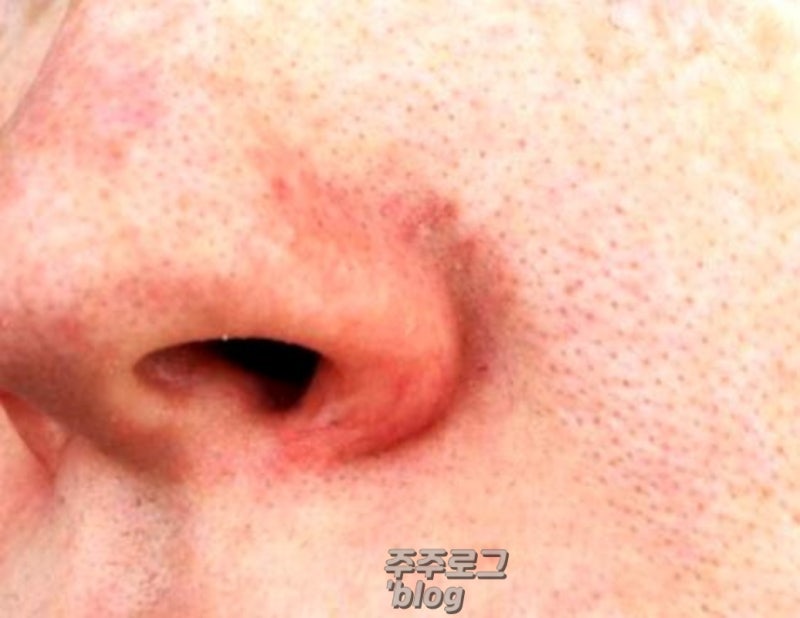 코옆 붉은기 코주변 빨개짐 원인 대체 뭐가 문제야?