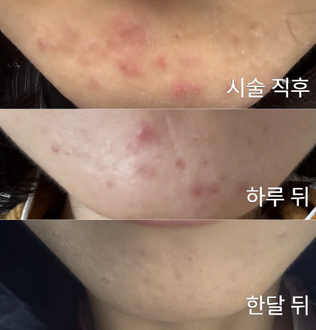 강남,안양,구로 아그네스 후기 | 여드름 아그네스 레이저 비교