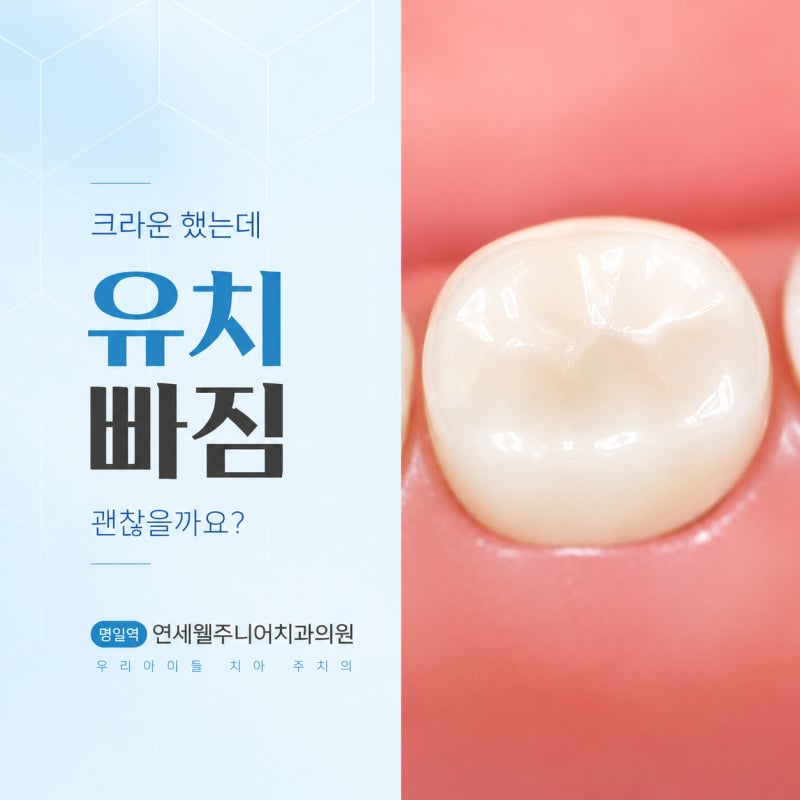 강동구소아치과 정보 유치 크라운을 씌운 치아가 흔들린다면?