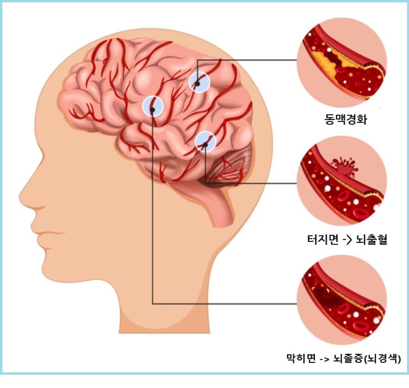 뇌혈관 보험 추천!