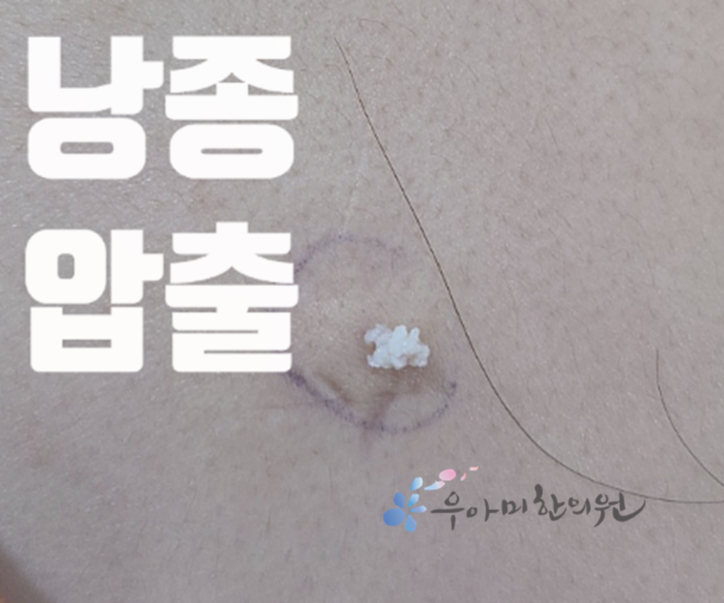 귀뒤 멍울•혹, 손끝에 잡히는 자리가 피지낭종의 단서가 됩니다