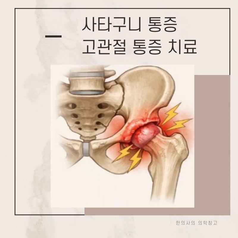 러닝 고관절 사타구니 통증 치료