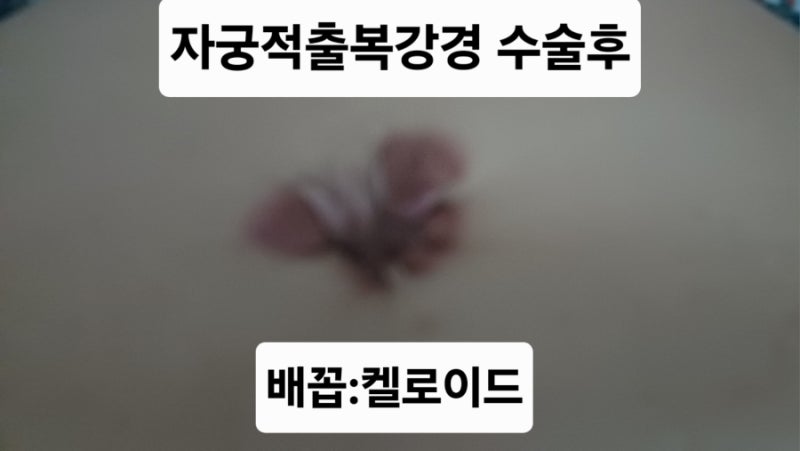 켈로이드 주사 건강보험 된다고? 딸 때문에 처음 알게 된 켈로이드, 내 배꼽이 거의 막힐 때....