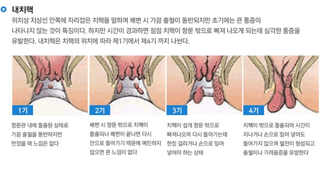고통스러운 임신 중 치질(치핵) 항문외과 진료 후기 / 치질약 정리 / 자연 치료 방법