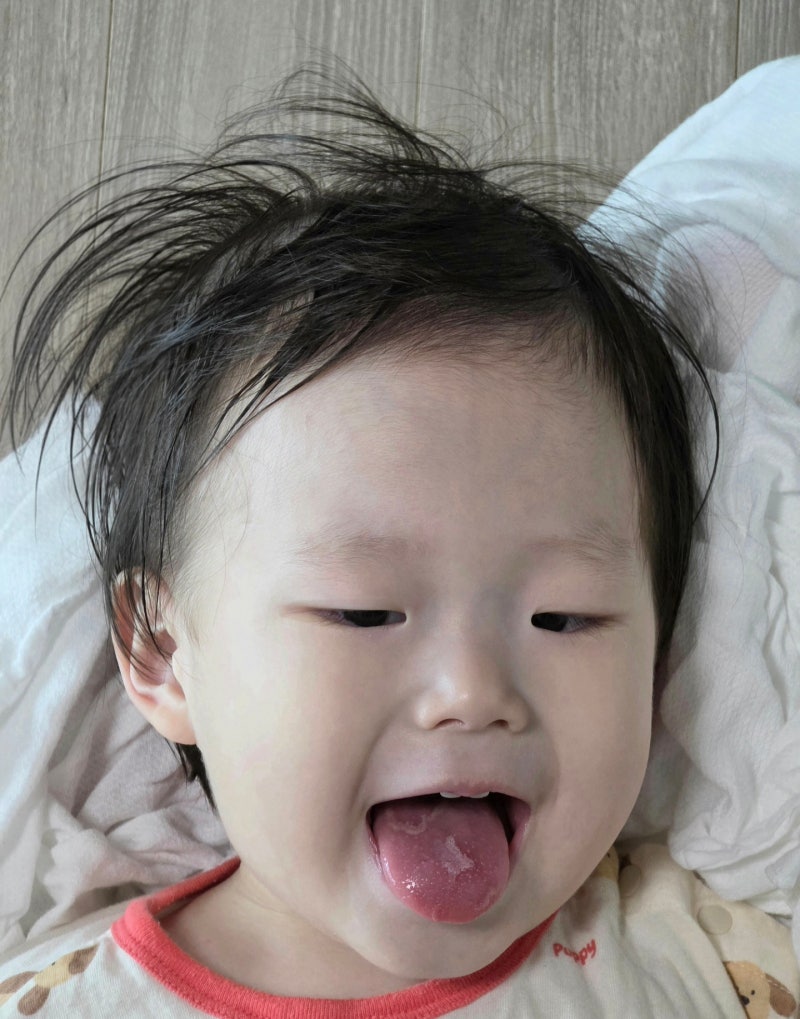 아기 구내염 아프타성구내염 원인 증상 빨리 낫는법 뭐가 있을까