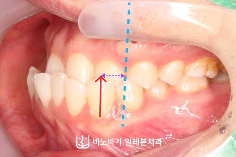 "앞니 치아가 거꾸로 물려요" (성인 주걱턱 반대교합 치아교정 진료 후기)
