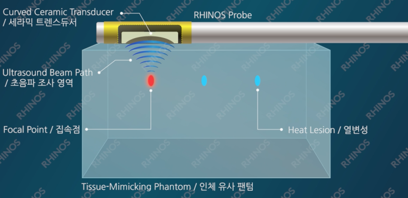 HIFU 초음파 하비갑개 축소술, 코블레이터·레이저·미세절삭기 방법과 어떻게 다를까요?