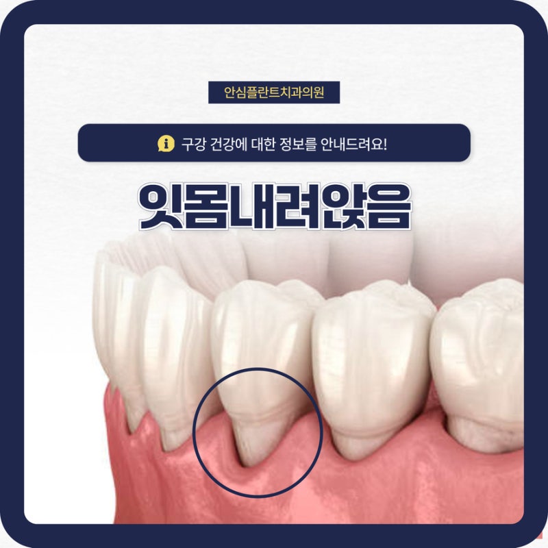 대구 치주치료 잇몸내려앉음 원인과 관리 방법은?