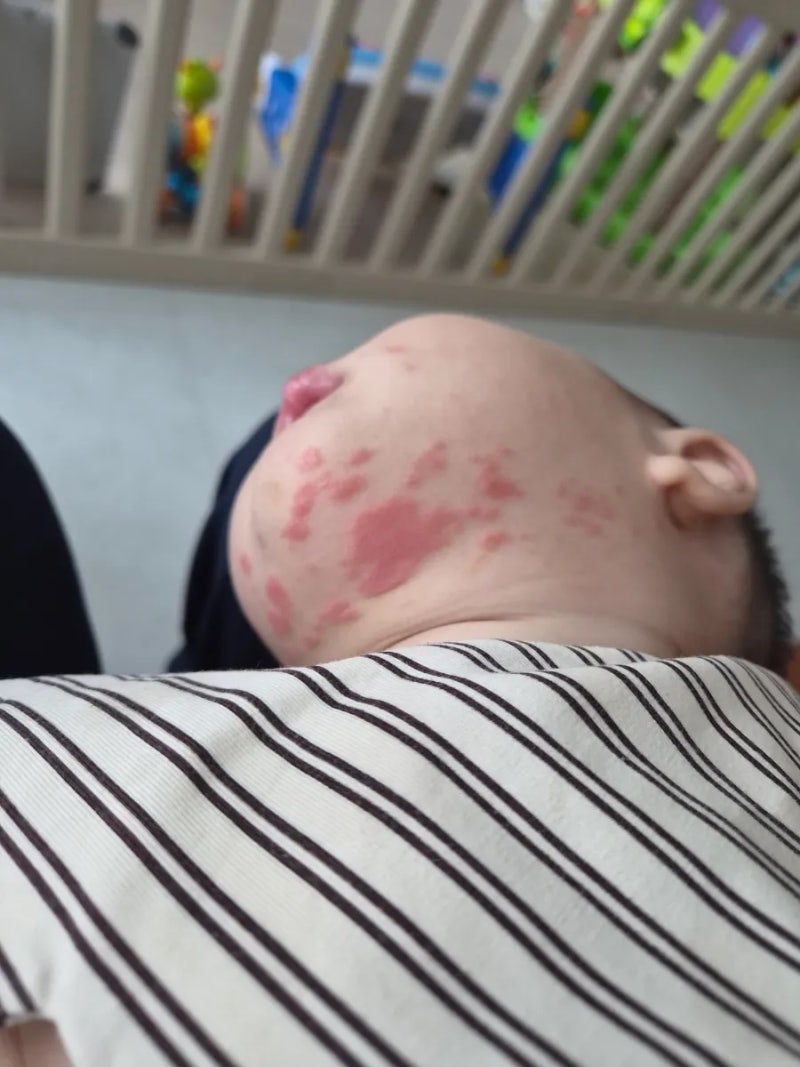 7개월 아기 침독 증상 관리 방법 리도맥스 연고 다 써보고 느낀 핵심 포인트 공유