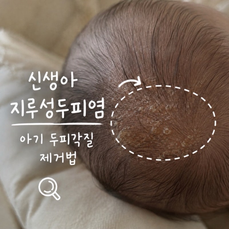 신생아 지루성두피염 증상 아기 두피각질 제거 방법